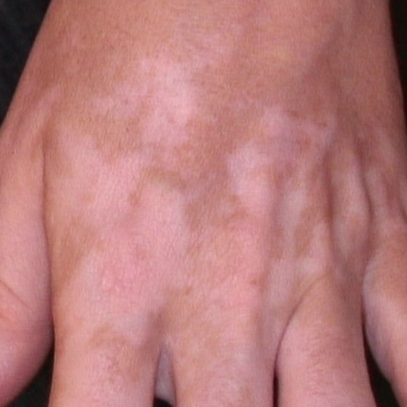 A karboxiterápia és a keskeny sávú ultraibolya B kombinációja a vitiligo ellenszegülő területeinek kezelésében: Randomizált klinikai vizsgálat