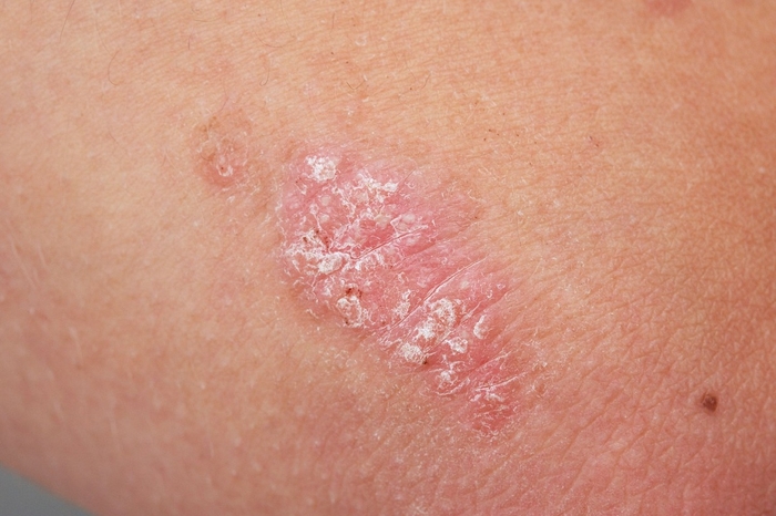 psoriasis