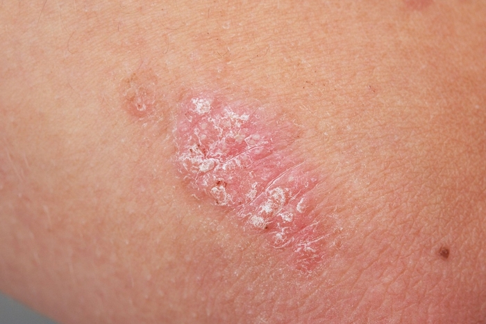 psoriasis