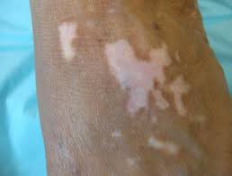 vitiligo