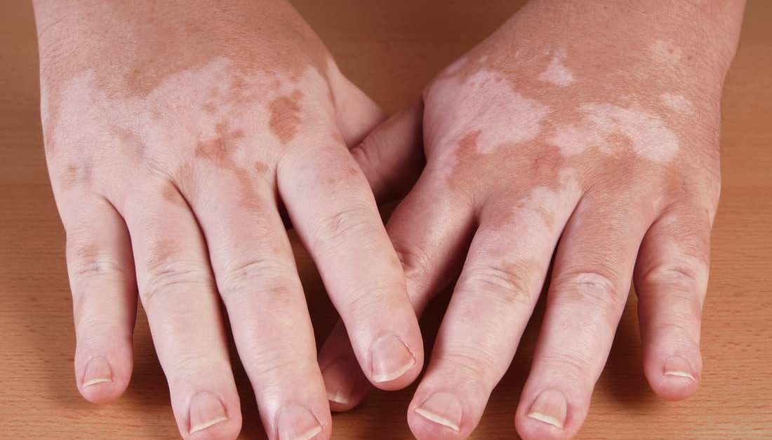 Ennek a szisztematikus áttekintésnek és a metaanalízisnek az eredményei arra utalnak, hogy az UV-fényterápia biztonságos kezelés a vitiligo számára, anélkül, hogy jelentős bőrrák kockázatot jelentene.